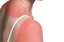 Previdno pri izpostavljenosti soncu: število novih primerov kožnega raka strmo narašča