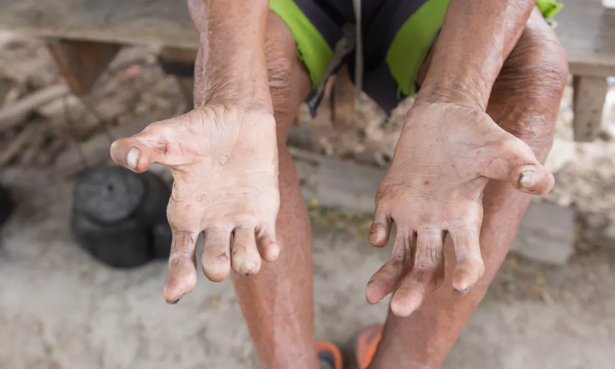 "Gobavost ni zelo nalezljiva, v Evropi primeri redki"