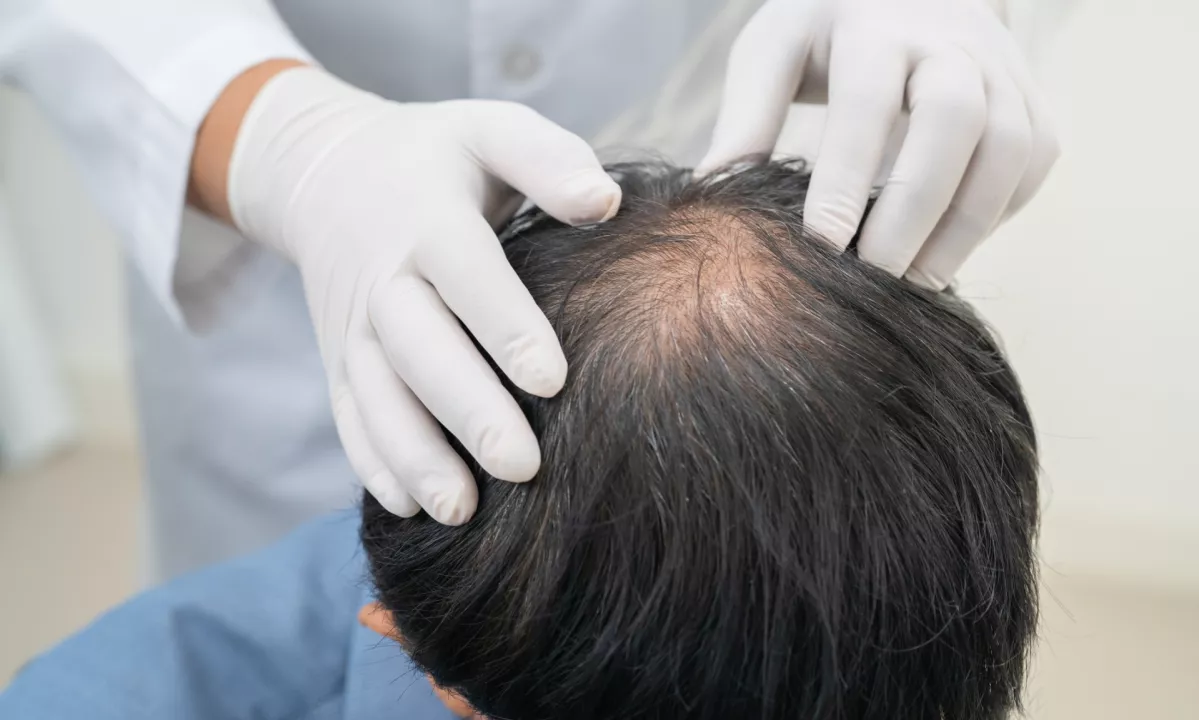 Južnokorejski predsednik želi financirati zdravljenje plešavosti iz javnih sredstev