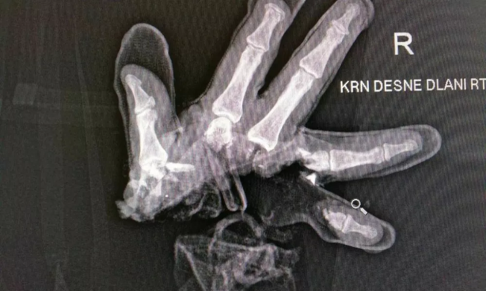 Po&scaron;kodbe pri nesrečah s pirotehniko so lahko zelo hude, po&scaron;kodovani pa lahko posledice nosi do konca življenja. 