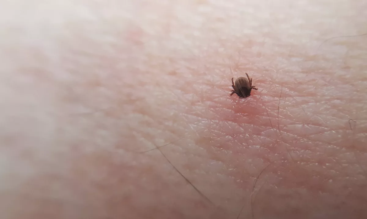 Mrliški oglednik je ugotovil, da je 16-letni Jeremy Webb umrl zaradi alergije na meso, ki jo je povzročil ugriz klopa.