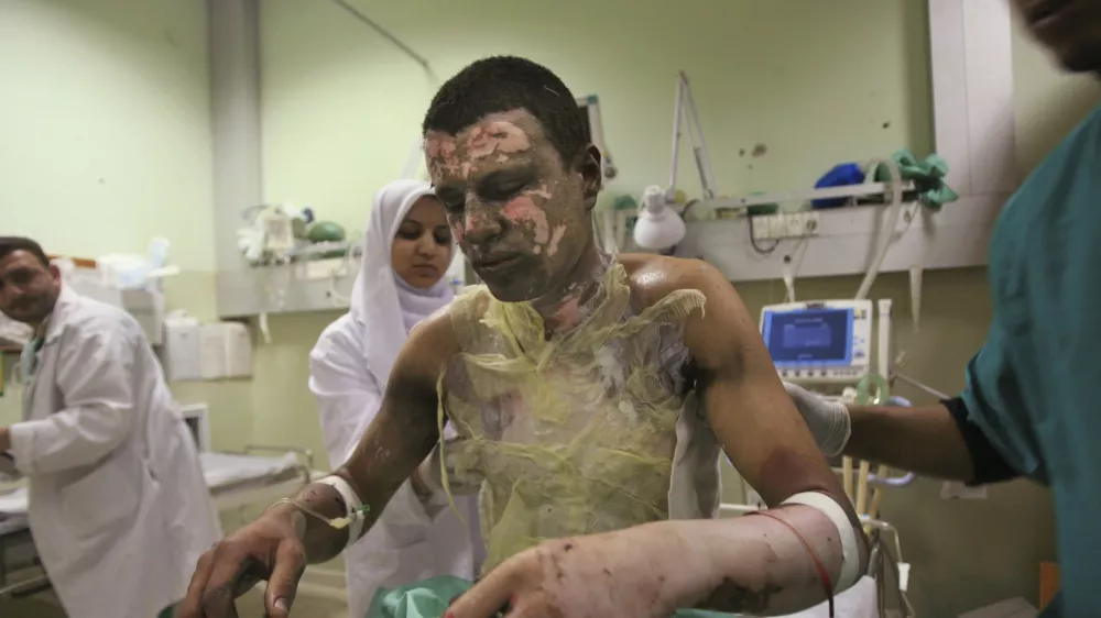 ** EDS NOTE GRAPHIC CONTENT ** Palestinian Akram Abu Roka is treated for burns at Nasser Hospital in Khan Younis in the southern Gaza Strip, Sunday, Jan. 11, 2009. The hospital's chief doctor said the injuries might have been caused by munitions containing white phosphorus. Human Rights Watch said Sunday that Israel's military has fired artillery shells packed with the incendiary agent over populated areas of Gaza, putting civilians at risk. (AP Photo/Eyad Baba)