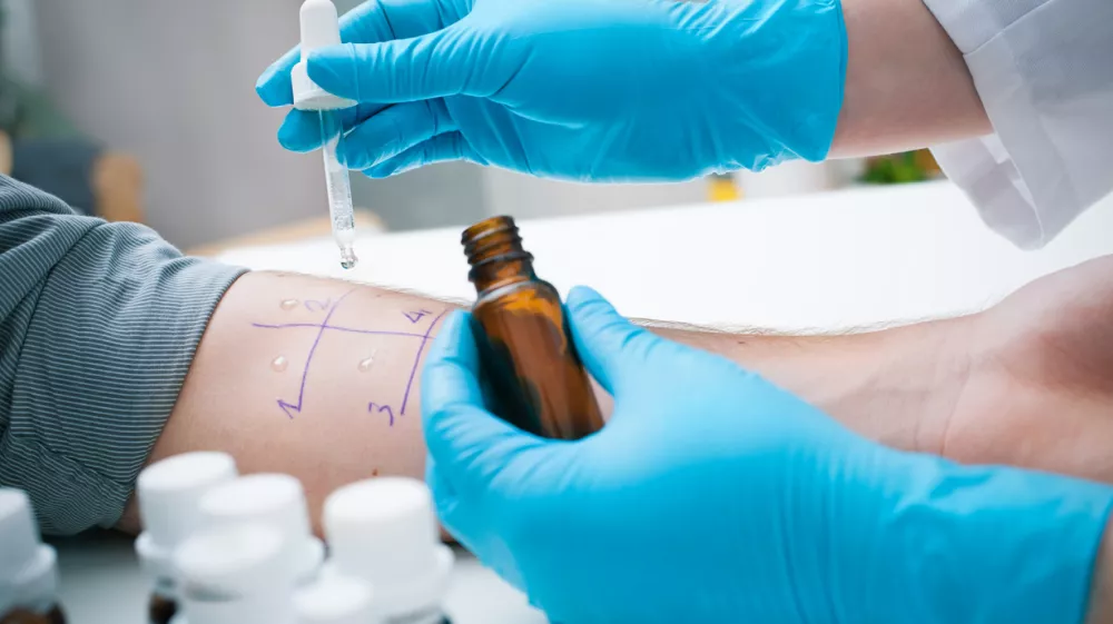 Skin prick allergy to find out kind of allergy / Foto: Alexraths Getty Images