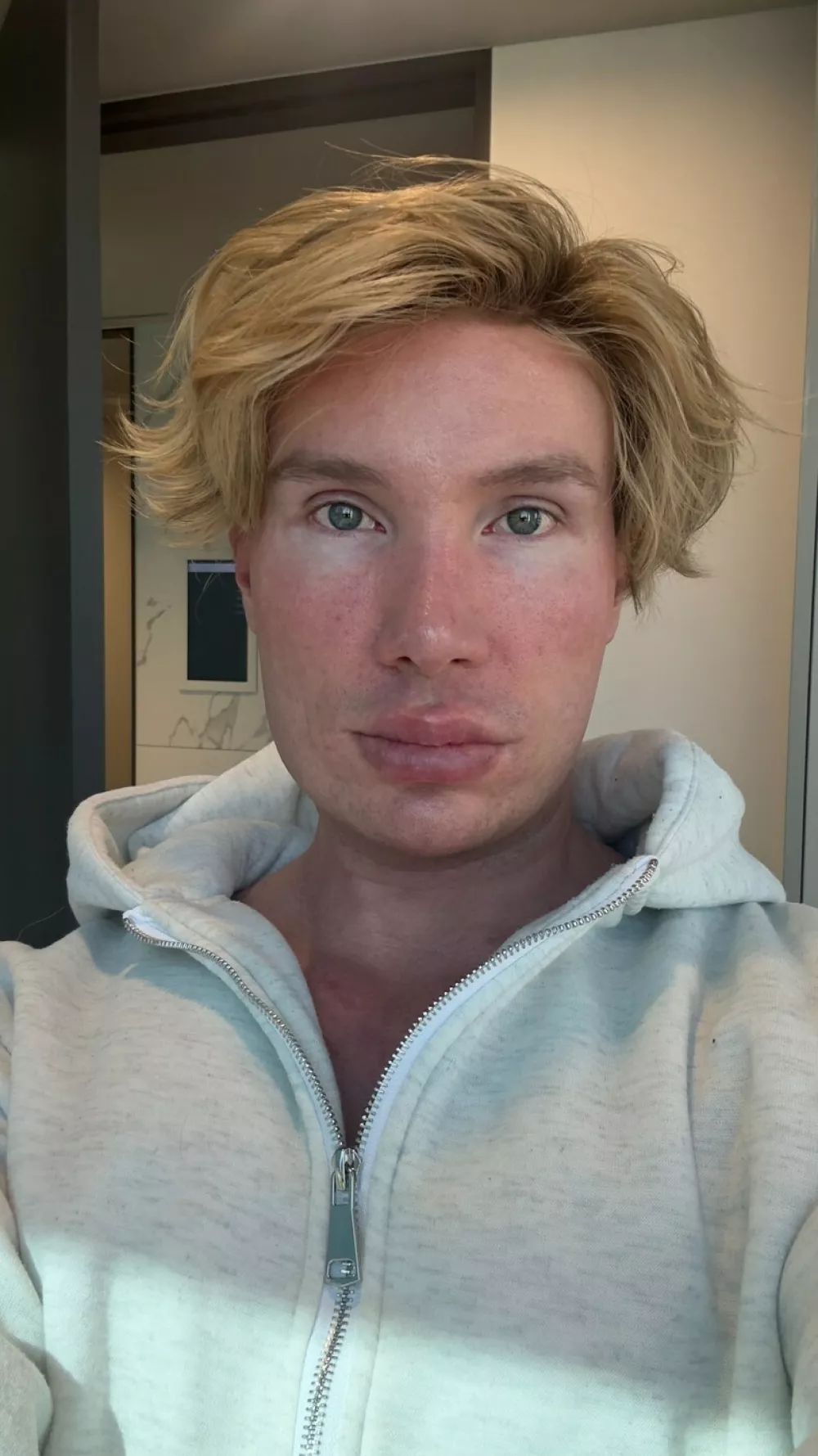 WARNING, GRAPHIC CONTENT -Story from Jam Press (Blind After Facelift)Pictured: Joni.Big Brother star left 'unrecognisable and BLIND' after undergoing extreme facelift that doctors in Turkey REFUSED to doAn influencer was left "unrecognisable and blind" after undergoing an extreme facelift that doctors in Turkey &ndash; a country known for its controversial procedures &ndash; refused to perform.Joni Hesselgren had previously undergone several procedures abroad with no issues including a rhinoplasty, a 360 liposuction and dental work.But when the reality TV star was denied his latest request, due to his age, he simply jetted off from Turkey to South Korea instead.He went under the knife to celebrate his 30th birthday."I consulted with several Turkish surgeons about the possibility of getting a lower facelift," the Big Brother Finland star told NeedToKnow."They told me they wouldn't perform a facelift on someone my age, and honestly, I do respect that decision."I've always been unhappy with how my jawline looks, so I thought maybe tightening the skin could help improve it."V-line surgery had been a dream of mine for several years but I was absolutely terrified of going through with it."I was desperately trying to find an alternative, something easier and faster that could give me a similar result."But as time went on, I realised I just had to man up and go through with the surgery I originally wanted."Joni travelled to the South Korean capital Seoul to undergo the operation.He ended up losing a lot of blood during the procedure.Joni said: "The surgeons suggested pairing my V-line surgery with a deep plane facelift."Of course I was thrilled to hear that because it meant I could get everything I ever wanted done in a single procedure."And I had three different surgeons working on me."One surgeon handled the facial contouring, which included V-line surgery and cheekbone reduction."Another performed the facelift, and a third did my lip lift."They told me afterwards that the surgery was more difficult than usual because I bled quite a lot during the procedure."The first night was pretty uncomfortable, I couldn't close my mouth properly, it just stayed open."When they discharged me the next morning, I took a taxi back to the Airbnb."That's when things really started to escalate and my swelling suddenly got much worse."Joni's troubles were about to get even worse on the second and third days after the operation.He said: "On day two, I started losing my eyesight."I tried to fight it by stretching my eyelids open so I could see something, anything."In the evening, my friends had to walk me to the bathroom, feed me, wash me, basically take care of everything for me."That second night, I barely slept. I was sitting there in the dark with my eyes completely swollen shut, unable to see anything."At one point, I even tried going to the bathroom by myself which, in hindsight, was a terrible idea considering I was basically blind and had zero awareness of my surroundings."I ended up hitting my head on the wall."Luckily for Joni, his friends woke up due to the noise and helped him to the bathroom.Joni spent that night crying because he had to remain upright and couldn't sleep.He said: "I had a follow-up appointment at the clinic on post-op day three, at this point I still couldn't see anything at all."I couldn't even tell whether it was day or night."My friends helped me into a taxi and guided me everywhere, I couldn't see shadows, lights, shapes, nothing."The only thing I could feel was the warmth of the sun on my face."When we arrived at the clinic, they immediately took me to a hyperbaric chamber for oxygen therapy."It's basically a pressurised chamber that feels a bit like being on a plane during takeoff or landing."Koreans really take their de-swelling treatments seriously because my eyes started to open within a few hours."The swelling went down super fast, I was so relieved."The total time I was effectively blind was about 12 to 15 hours."I can't wait to see the final results."I guess we'll see them in about six months!"Joni also had advice for anyone thinking about undergoing similar procedures in a foreign country.He added: "If you ever consider going through this many procedures, please take a friend with you."The recovery process is physically exhausting, but it's a lot to go through mentally as well."You really need love and support during that time."ENDSEDITOR'S NOTE: Video Usage Licence: (EXCLUSIVE) We have obtained an exclusive licence from the copyright holder. A copy of the licence is available on request.Video Restrictions: None.,Image: 1093447474, License: Rights-managed, Restrictions: EDITOR'S NOTE: Video Usage Licence: (EXCLUSIVE) We have obtained an exclusive licence from the copyright holder. A copy of the licence is available on request.Video Restrictions: None., Model Release: no 