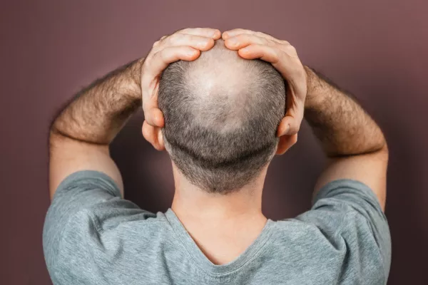 Self-doubt and inferiority complex. Baldy adult man grabs his head with his hands. Rear view. Brown background. The concept of alopecia and baldness. / Foto: Ildar Abulkhanov