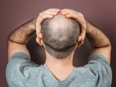 Self-doubt and inferiority complex. Baldy adult man grabs his head with his hands. Rear view. Brown background. The concept of alopecia and baldness. / Foto: Ildar Abulkhanov