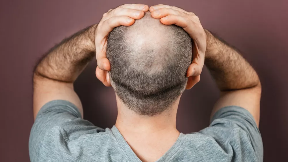 Self-doubt and inferiority complex. Baldy adult man grabs his head with his hands. Rear view. Brown background. The concept of alopecia and baldness. / Foto: Ildar Abulkhanov