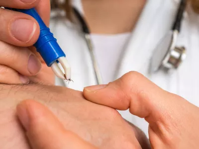 Female doctor removing a tick with tweezers from hand of patient. Encephalitis, borreliosis and lyme disease. / Foto: Andriano_cz