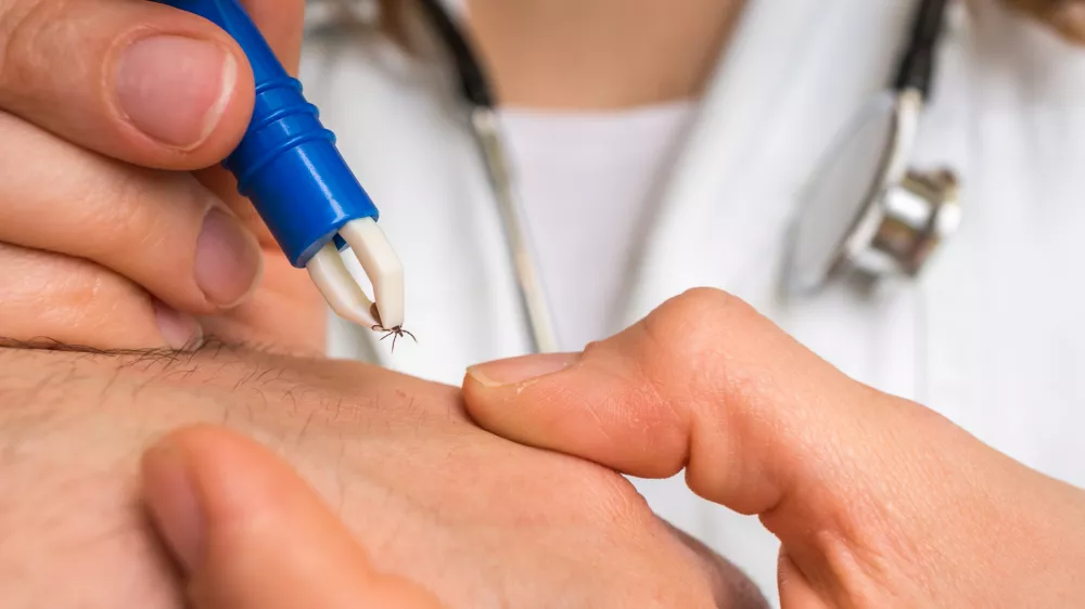 Female doctor removing a tick with tweezers from hand of patient. Encephalitis, borreliosis and lyme disease. / Foto: Andriano_cz