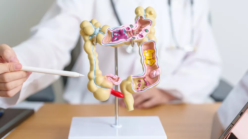 Doctor with human Colon anatomy model and tablet. Colonic disease, Large Intestine, Colorectal cancer, Ulcerative colitis, Diverticulitis, Irritable bowel syndrome and Digestive system