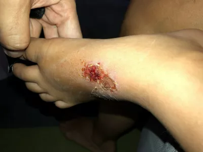 impetigo, akterijska okužba, okužba, rdečkaste ranice / Foto: Matjaž Terzič