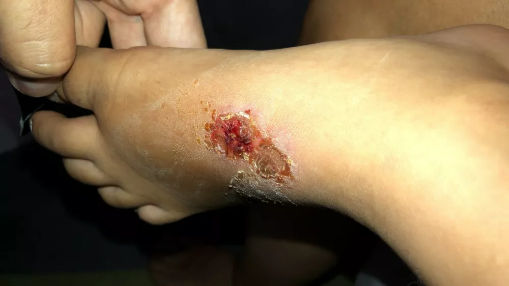 impetigo, akterijska okužba, okužba, rdečkaste ranice / Foto: Matjaž Terzič
