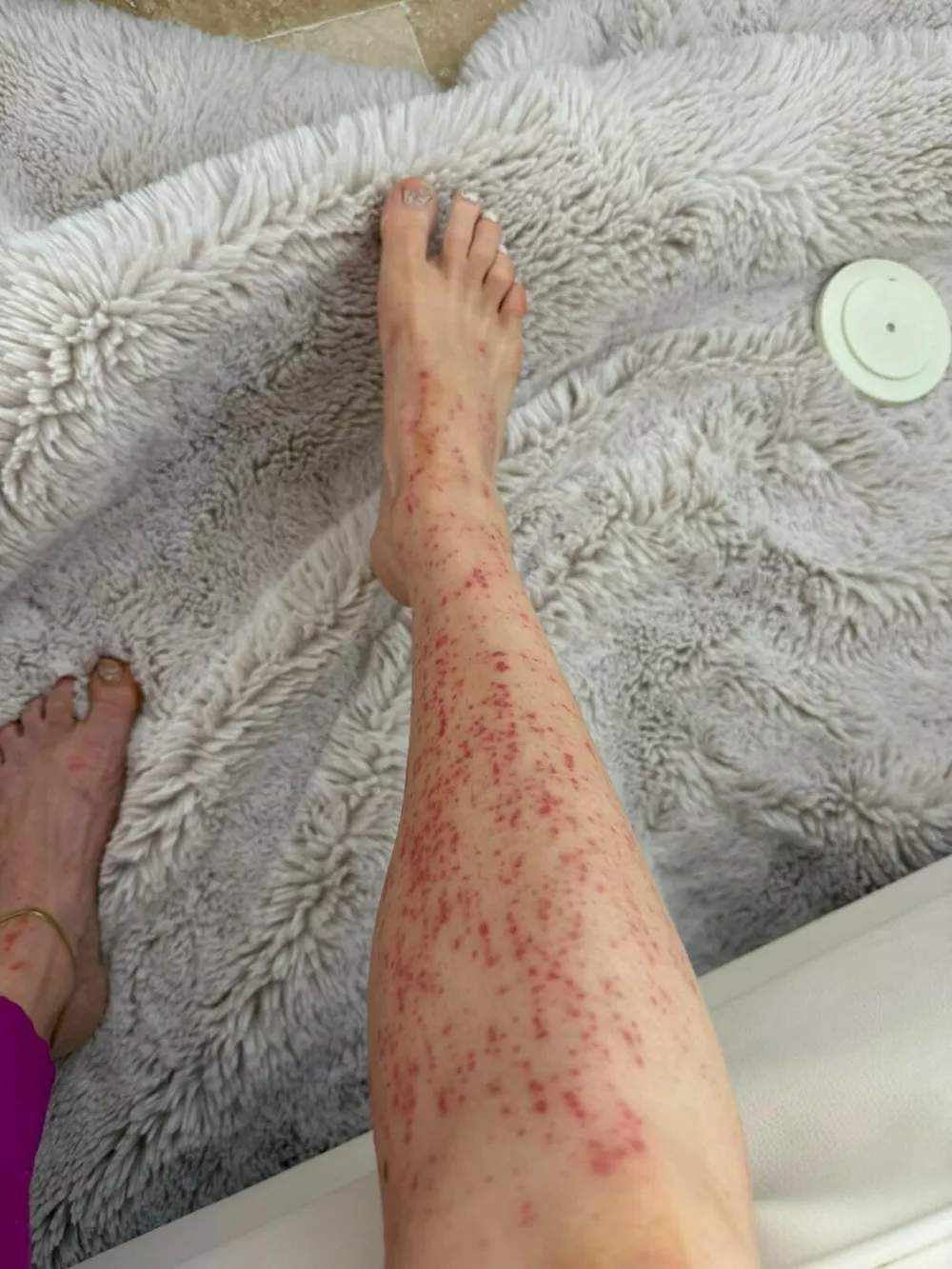 Story from Jam Press (Extreme Allergic Reaction)Pictured: Aleksandra's legs showing visible red marks from the allergic reaction.Mum-of-five suffers extreme allergic reaction after cutting down toxic plants in own gardenA mum-of-five was left covered in an agonising rash within minutes of cutting down agave plants in her garden after toxic sap sprayed onto her skin.Aleksandra Schmidt, 42, had been removing overgrown agave plants around her pool as part of a DIY landscaping project at her home in Florida.She had several agave plants in the garden, with five on each side of the pool, and had decided to remove one row because they had become too large for the space.Aleksandra, who splits her time between the Tampa and Fort Lauderdale areas, said she knew the plants were sharp but had no idea their sap could trigger such a severe reaction.Using a chainsaw after finding her machete wasn't sharp enough, she was showered with agave sap and shards as she cut through the plants.Within minutes, she noticed an intense stinging sensation on her legs.Aleksandra said: "It felt like multiple bee stings."When I looked down, I saw countless reddish-copper spots on my legs."At first, I thought I had somehow cut myself and was bleeding."The itching quickly became unbearable.She ran into her swimming pool before realising the red spots were actually tiny agave shards stuck all over her skin.Aleksandra rushed inside and got into the shower, desperately rubbing the affected areas because it was the only thing that brought any relief.She said: "My legs became extremely irritated and inflamed."What worried me most was that I started getting chills and generally felt very strange."I wasn't sure how severe the reaction might become."It quickly became obvious this was much more than a minor rash or simple skin irritation."Aleksandra suffered redness, burning, itching and chills but, thankfully, did not experience breathing difficulties or anaphylaxis.She applied hydrocortisone cream after showering and believes taking an Allegra tablet earlier that morning for seasonal allergies may also have helped.It gradually disappeared over the following four days without the need for hospital treatment, as reported by NeedToKnow.Now fully recovered, Aleksandra says there is no sign the incident ever happened.She added: "I cut a plant that, unbeknownst to me, could cause a severe reaction."I learned something new and now I know."My biggest takeaway is that many people, like me, may not realise agave sap can cause severe skin reactions, especially when combined with sun exposure."If sharing my experience helps even one person avoid going through the same thing, then it was worth talking about."The video documenting Aleksandra's horrifying reaction, shared Wednesday (27 May) has been viewed more than three million times on social media, with thousands of users sharing their thoughts.One person said: "I had zero knowledge of this. Thank you for spreading awareness."Another wrote: "Hardcore! Gardening can be dangerous."Someone else added: "Thank you for sharing this education. I would have never known."A fourth commented: "Oh my!! That looks terribly painful!! You're brave to post this. You will save someone else pain and misery. I absolutely hate those plants. They're scary looking."However, not everyone was sympathetic.One viewer wrote: "It's the flip flops and sweats pulled to knees while using a chainsaw for me."ENDSEDITOR'S NOTE: Exclusive Licence: An exclusive licence has been obtained directly from the verified copyright holder. Jam Press holds exclusive distribution rights for the agreed content within the terms of the contributor agreement.,Image: 1116795137, License: Rights-managed, Restrictions: EDITOR'S NOTE: Exclusive Licence: An exclusive licence has been obtained directly from the verified copyright holder. Jam Press holds exclusive distribution rights for the agreed content within the terms of the contributor agreement., Model Release: no 