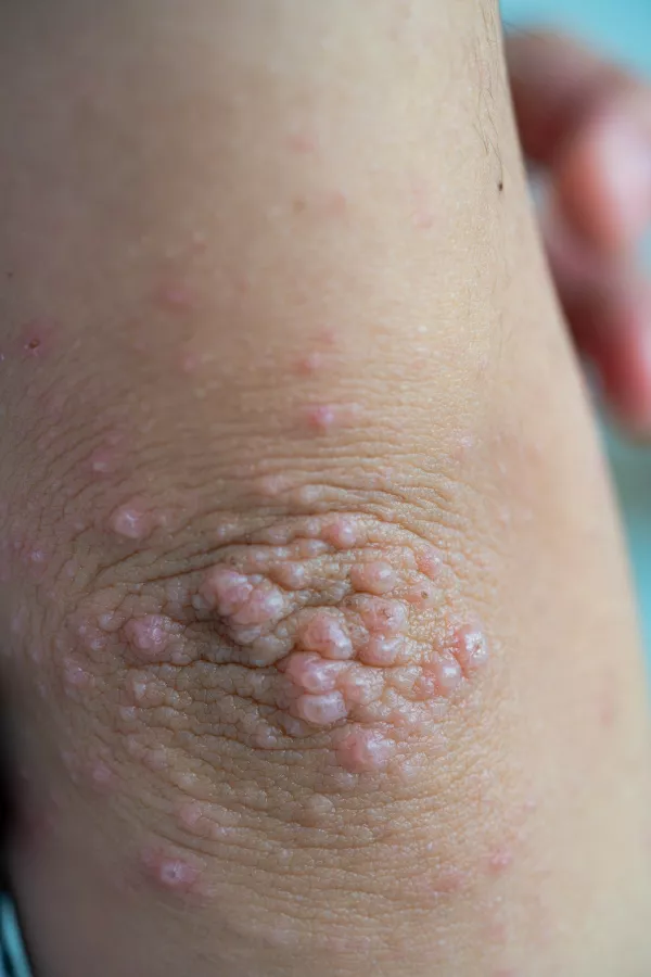 Izpu&scaron;čaji so videti grozno, toda običajno so povsem nenevarni. Foto: iStock