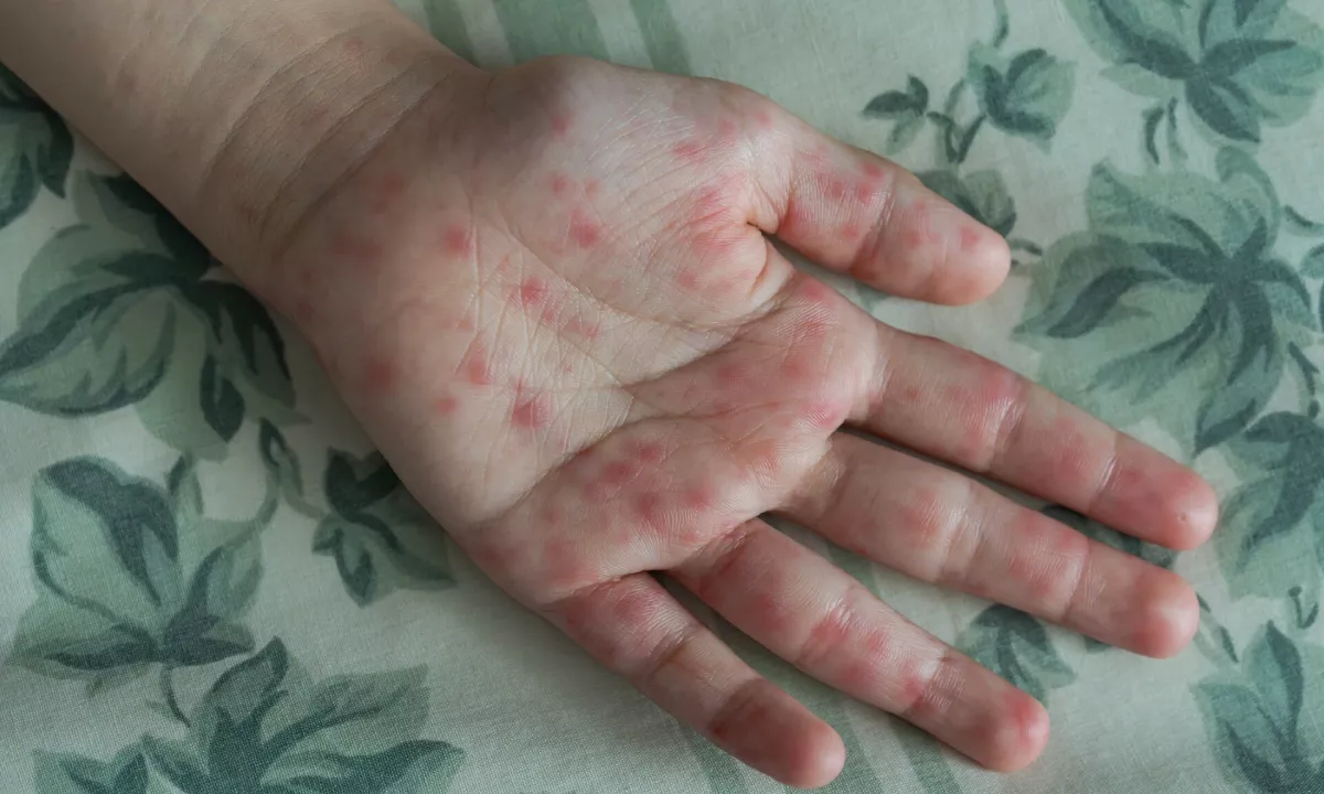Ne le opekline in vročina: poletje prinaša skriti val nalezljive otroške bolezni
