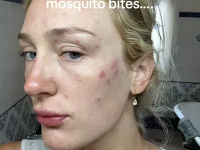 Story from Jam Press (Mosquito Bites Wedding)Pictured: Auja's skin swollen with mosquito bites.'I was eaten alive by mosquitoes just before my wedding &ndash; then I woke up covered in 50 swollen bites on the big day'A bride woke up covered in more than 50 swollen mosquito bites on the morning of her wedding after sleeping with the doors open when the air conditioning in her accommodation broke.Auja Smith tied the know with husband, Nikhi Singh, 30, in Mallorca, Spain, on 5 June.The 26-year-old's wedding celebrations took an unexpected turn after their air conditioning unit stopped working two nights before the ceremony, leaving them to sleep with the doors open to escape the heat.When Auja, who works in commercial art sales, woke the following morning, she noticed dozens of flat red marks scattered across her body."I woke up two nights before the wedding and there were bites all over me but they were flat and just red," Auja, from Indianapolis, US, told creatorzine.com."I freaked out."There were mosquitoes swarming the room because we had slept with the doors open in our bedroom because our AC went out and it's very hot."The next morning, I got up to go into our closet and as soon as I opened the closet doors, there were 50-plus mosquitoes in the closet almost hibernating."The couple rushed out to buy insect spray to stop any more mosquitoes getting into the room but by the following morning, which was also the day of the wedding, the bites had become significantly worse.Auja said: "I woke up the day of my wedding and all of the mosquito bites had gotten extremely swollen."I had been taking antihistamines the day before and even slept with pimple patches on to try to mitigate."But nonetheless, I woke up and they were extremely swollen."Nothing like the day before."I went into solution, problem-solving mode and took more allergy pills and put Benadryl cream all over myself and iced them."I did everything that I could think of that might help, but quite literally nothing helped."Auja said she tried her best to enjoy her big day.She said: "The boys went off for the day to run errands and it was me and a few of my friends at the house and I finally as I was starting to get ready, I just broke down and started crying."After that, I tried to just forget about it and accept that it was going to be a part of the day."I wasn't intending on wearing a lot of makeup that day and because of how swollen they were, I ended up wearing five layers of foundation, and I told my photographer she better be good at Photoshop."Auja is encouraging other couples planning destination weddings to prepare for unexpected problems.She added: "My warning to brides getting married anywhere abroad is don't do anything out of the normal and definitely don't sleep with the doors or windows open even if it's hot."When you think that you're prepared, think of every in any situation that could possibly happen and make sure you bring every medicine you have available."Looking back, Auja said she believes every wedding has something that goes wrong and that the mishaps only made the day more memorable.She added: "I would like to say that I think that every single person's wedding day has something that goes wrong and there were more than just the bites that went wrong on our special day."But when you are genuinely in love and so happy, there's nothing that could get in the way of making the day the best day of your life."So I wouldn't stress too much about what could go wrong and focusing on what's right."And at the end of the day, I got to marry the love of my life and it was the most wonderful, fairytale wedding that I could've asked for."What God joins together let no one separate."Anything that happens that could be perceived as negative or going wrong on your wedding day makes it even more memorable and a part of the day."So many people focus on perfection of the day instead of what it's actually about."ENDSEDITOR'S NOTE: Exclusive Licence: An exclusive licence has been obtained directly from the verified copyright holder. Jam Press holds exclusive distribution rights for the agreed content within the terms of the contributor agreement.,Image: 1118177537, License: Rights-managed, Restrictions: EDITOR'S NOTE: Exclusive Licence: An exclusive licence has been obtained directly from the verified copyright holder. Jam Press holds exclusive distribution rights for the agreed content within the terms of the contributor agreement., Model Release: no 