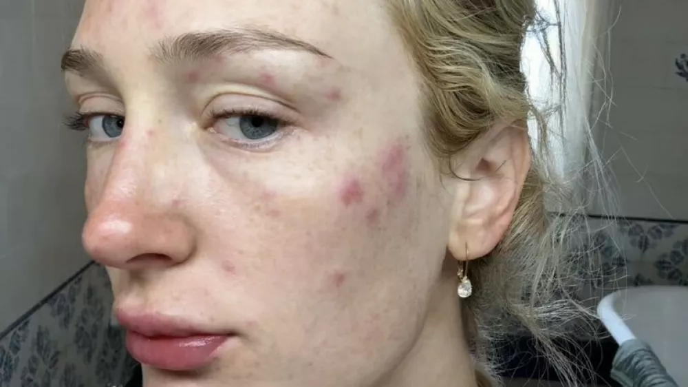 Story from Jam Press (Mosquito Bites Wedding)Pictured: Auja's skin swollen with mosquito bites.'I was eaten alive by mosquitoes just before my wedding &ndash; then I woke up covered in 50 swollen bites on the big day'A bride woke up covered in more than 50 swollen mosquito bites on the morning of her wedding after sleeping with the doors open when the air conditioning in her accommodation broke.Auja Smith tied the know with husband, Nikhi Singh, 30, in Mallorca, Spain, on 5 June.The 26-year-old's wedding celebrations took an unexpected turn after their air conditioning unit stopped working two nights before the ceremony, leaving them to sleep with the doors open to escape the heat.When Auja, who works in commercial art sales, woke the following morning, she noticed dozens of flat red marks scattered across her body."I woke up two nights before the wedding and there were bites all over me but they were flat and just red," Auja, from Indianapolis, US, told creatorzine.com."I freaked out."There were mosquitoes swarming the room because we had slept with the doors open in our bedroom because our AC went out and it's very hot."The next morning, I got up to go into our closet and as soon as I opened the closet doors, there were 50-plus mosquitoes in the closet almost hibernating."The couple rushed out to buy insect spray to stop any more mosquitoes getting into the room but by the following morning, which was also the day of the wedding, the bites had become significantly worse.Auja said: "I woke up the day of my wedding and all of the mosquito bites had gotten extremely swollen."I had been taking antihistamines the day before and even slept with pimple patches on to try to mitigate."But nonetheless, I woke up and they were extremely swollen."Nothing like the day before."I went into solution, problem-solving mode and took more allergy pills and put Benadryl cream all over myself and iced them."I did everything that I could think of that might help, but quite literally nothing helped."Auja said she tried her best to enjoy her big day.She said: "The boys went off for the day to run errands and it was me and a few of my friends at the house and I finally as I was starting to get ready, I just broke down and started crying."After that, I tried to just forget about it and accept that it was going to be a part of the day."I wasn't intending on wearing a lot of makeup that day and because of how swollen they were, I ended up wearing five layers of foundation, and I told my photographer she better be good at Photoshop."Auja is encouraging other couples planning destination weddings to prepare for unexpected problems.She added: "My warning to brides getting married anywhere abroad is don't do anything out of the normal and definitely don't sleep with the doors or windows open even if it's hot."When you think that you're prepared, think of every in any situation that could possibly happen and make sure you bring every medicine you have available."Looking back, Auja said she believes every wedding has something that goes wrong and that the mishaps only made the day more memorable.She added: "I would like to say that I think that every single person's wedding day has something that goes wrong and there were more than just the bites that went wrong on our special day."But when you are genuinely in love and so happy, there's nothing that could get in the way of making the day the best day of your life."So I wouldn't stress too much about what could go wrong and focusing on what's right."And at the end of the day, I got to marry the love of my life and it was the most wonderful, fairytale wedding that I could've asked for."What God joins together let no one separate."Anything that happens that could be perceived as negative or going wrong on your wedding day makes it even more memorable and a part of the day."So many people focus on perfection of the day instead of what it's actually about."ENDSEDITOR'S NOTE: Exclusive Licence: An exclusive licence has been obtained directly from the verified copyright holder. Jam Press holds exclusive distribution rights for the agreed content within the terms of the contributor agreement.,Image: 1118177537, License: Rights-managed, Restrictions: EDITOR'S NOTE: Exclusive Licence: An exclusive licence has been obtained directly from the verified copyright holder. Jam Press holds exclusive distribution rights for the agreed content within the terms of the contributor agreement., Model Release: no 