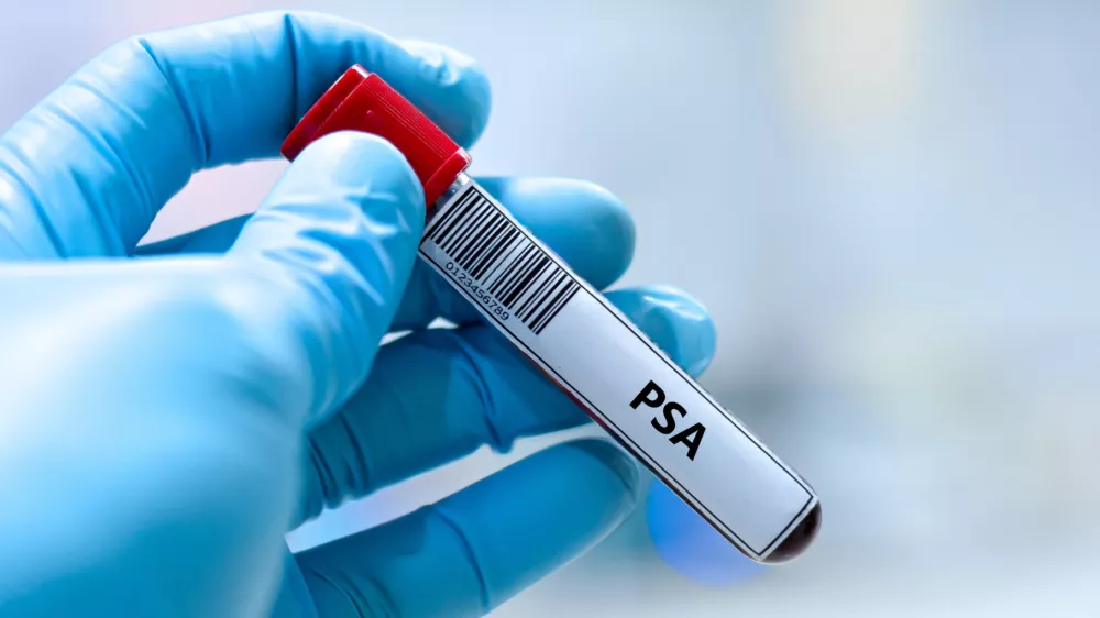 PSA test, prostata