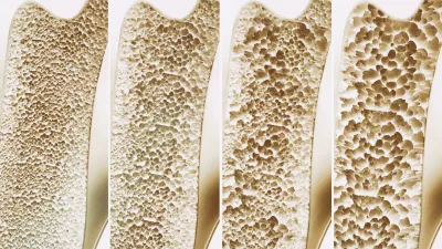 V oddaji bomo poudarili pomen zgodnjega odkrivanja&nbsp;bolnikov, pri katerih obstaja visoko tveganje za osteoporozne zlome. Foto: Reuters/Alamy / Foto: Foto: Reuters/alamy