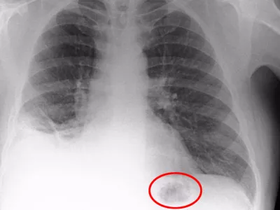 The blockage in the bottom right of the X-Ray (L) before it was removed and Paul's lungs once the toy cone was removed (R). A man who inhaled a Playmobil cone that was lodged in his lung for 40 years has spoken out about his ordeal. See ROSS PARRY story RPYCONE. Doctors feared father-of-two Paul Baxter had cancer after a dark mass was found on his chest - only to discover on the operating table it was part of a police traffic set he had received as a seventh birthday present. The postman had initially been referred to his local hospital after months of ill health, complaining about a persistent cough. Amazingly Paul, who is now 50, cannot remember inhaling the cone.,Image: 350730336, License: Rights-managed, Restrictions: follow us on twitter - @swnsbrowse our website - swns.comemail pix@swns.com, Model Release: no 