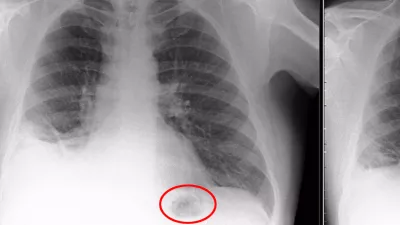 The blockage in the bottom right of the X-Ray (L) before it was removed and Paul's lungs once the toy cone was removed (R). A man who inhaled a Playmobil cone that was lodged in his lung for 40 years has spoken out about his ordeal. See ROSS PARRY story RPYCONE. Doctors feared father-of-two Paul Baxter had cancer after a dark mass was found on his chest - only to discover on the operating table it was part of a police traffic set he had received as a seventh birthday present. The postman had initially been referred to his local hospital after months of ill health, complaining about a persistent cough. Amazingly Paul, who is now 50, cannot remember inhaling the cone.,Image: 350730336, License: Rights-managed, Restrictions: follow us on twitter - @swnsbrowse our website - swns.comemail pix@swns.com, Model Release: no 